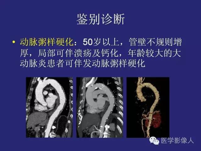【PPT】大动脉炎分型及CT诊断