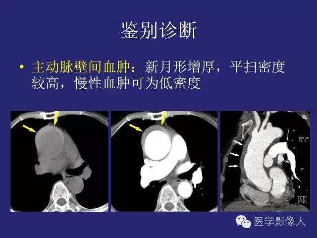 【PPT】大动脉炎分型及CT诊断