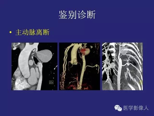 【PPT】大动脉炎分型及CT诊断