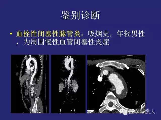 【PPT】大动脉炎分型及CT诊断