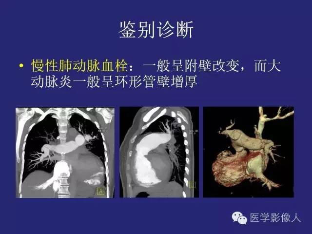 【PPT】大动脉炎分型及CT诊断
