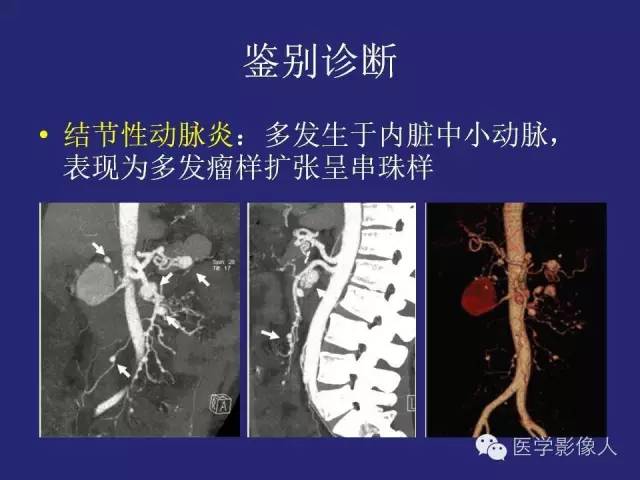 【PPT】大动脉炎分型及CT诊断