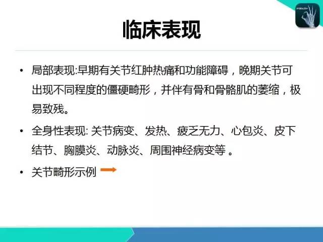 【PPT】类风湿性关节炎