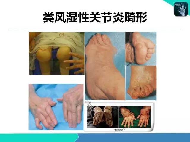 【PPT】类风湿性关节炎