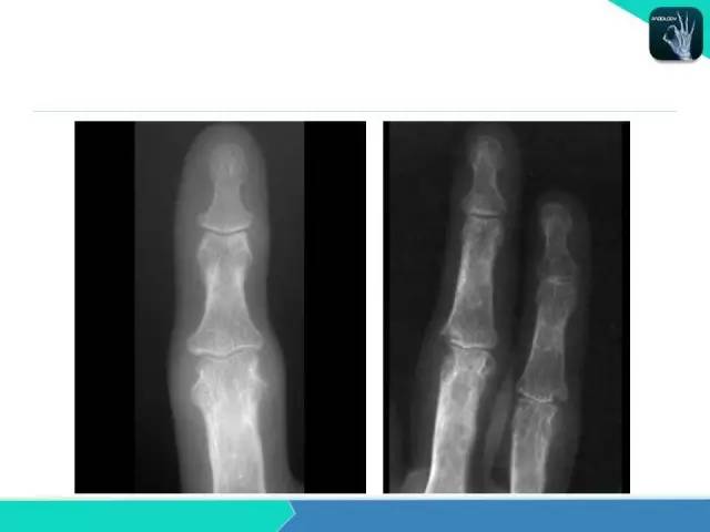 【PPT】类风湿性关节炎