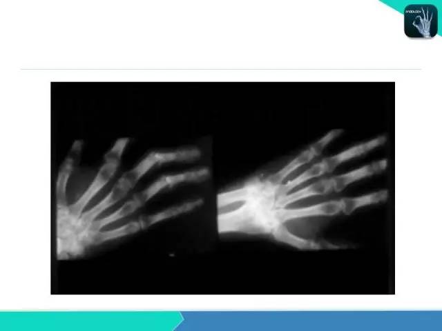 【PPT】类风湿性关节炎