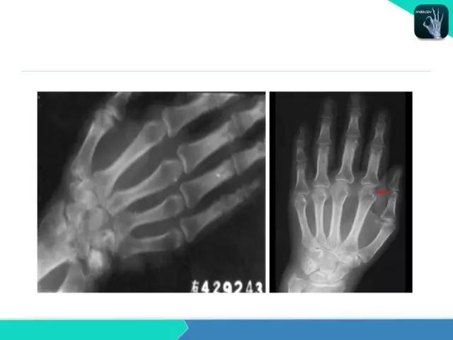 【PPT】类风湿性关节炎