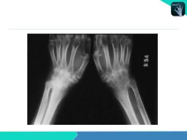 【PPT】类风湿性关节炎
