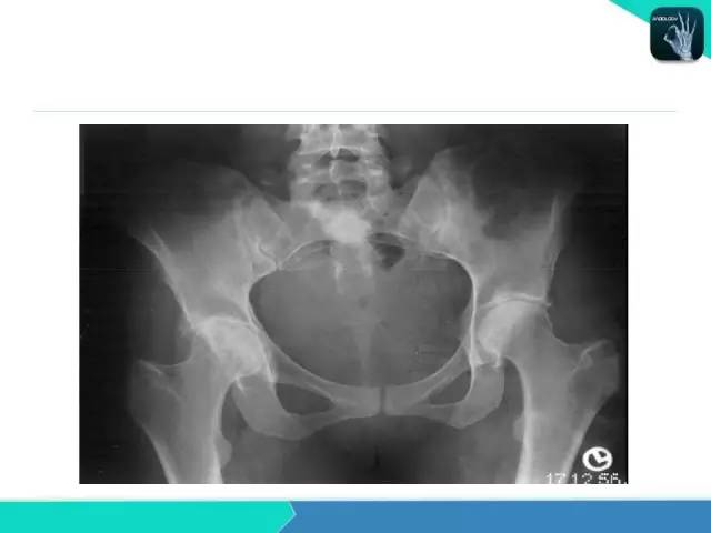 【PPT】类风湿性关节炎