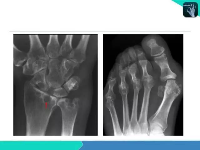 【PPT】类风湿性关节炎