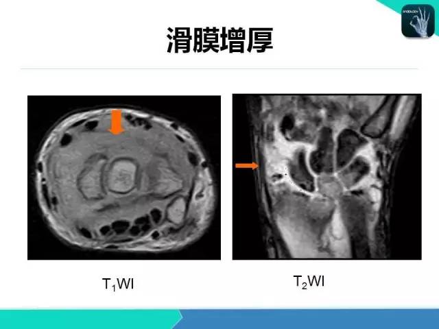 【PPT】类风湿性关节炎