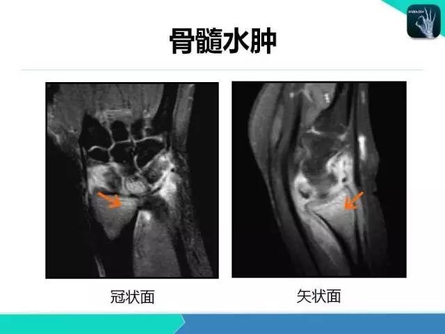 【PPT】类风湿性关节炎