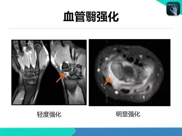【PPT】类风湿性关节炎
