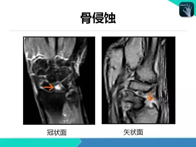 【PPT】类风湿性关节炎