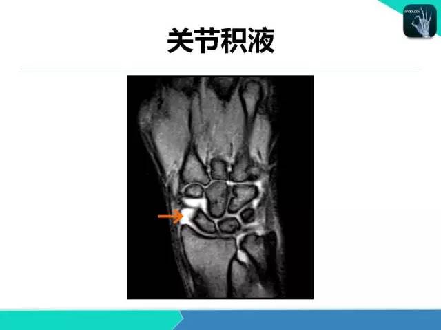 【PPT】类风湿性关节炎