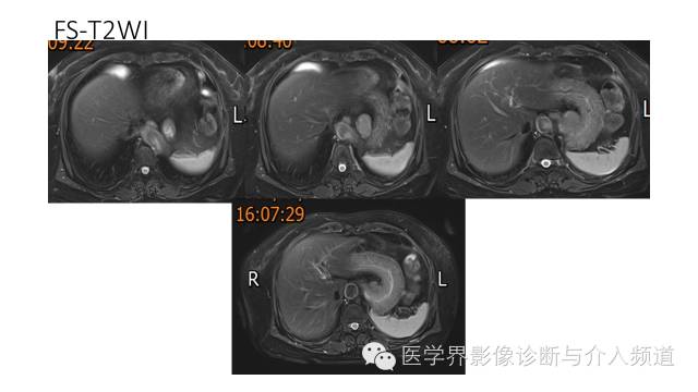 【病例】胃底部胃肠道间质瘤1例MR影像表现