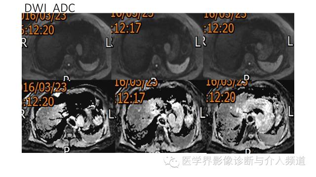 【病例】胃底部胃肠道间质瘤1例MR影像表现 【病例】胃底部胃肠道间质瘤1例MR影像表现