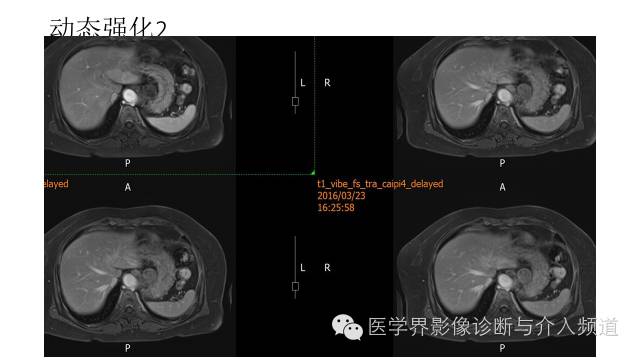 【病例】胃底部胃肠道间质瘤1例MR影像表现 【病例】胃底部胃肠道间质瘤1例MR影像表现