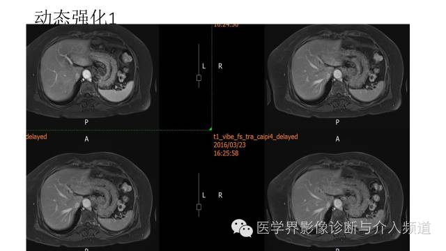 【病例】胃底部胃肠道间质瘤1例MR影像表现 【病例】胃底部胃肠道间质瘤1例MR影像表现