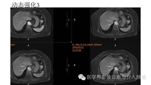 【病例】胃底部胃肠道间质瘤1例MR影像表现 【病例】胃底部胃肠道间质瘤1例MR影像表现