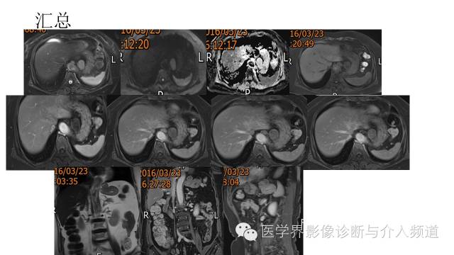 【病例】胃底部胃肠道间质瘤1例MR影像表现 【病例】胃底部胃肠道间质瘤1例MR影像表现