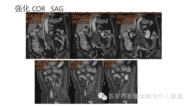 【病例】胃底部胃肠道间质瘤1例MR影像表现 【病例】胃底部胃肠道间质瘤1例MR影像表现
