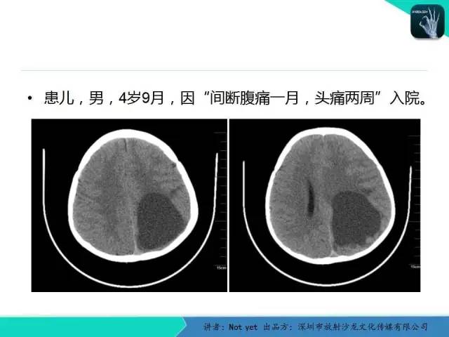 【病例】室管膜瘤一例MR影像表现