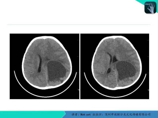 【病例】室管膜瘤一例MR影像表现