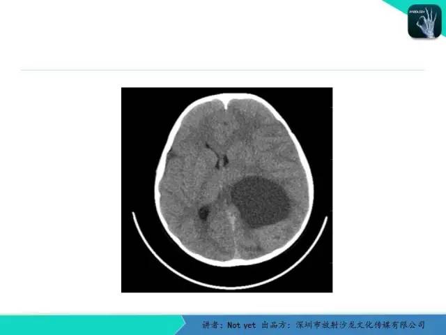【病例】室管膜瘤一例MR影像表现