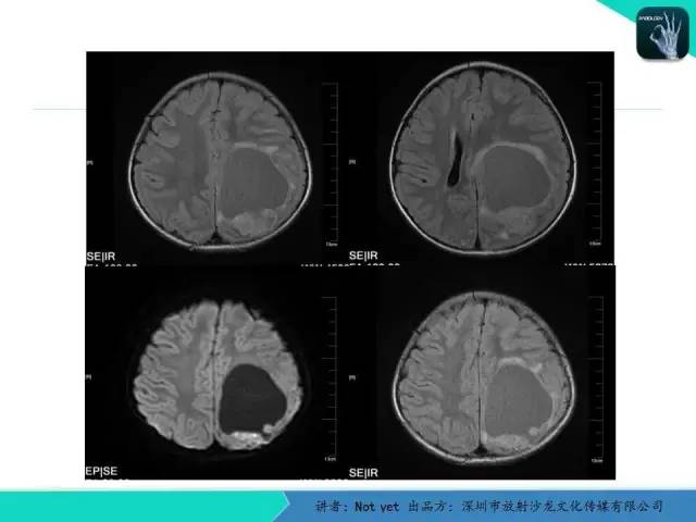 【病例】室管膜瘤一例MR影像表现