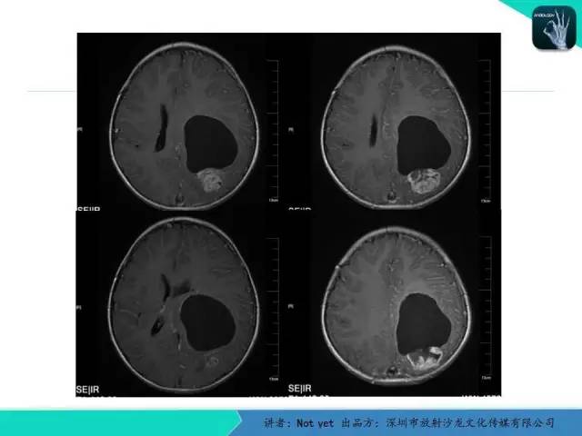 【病例】室管膜瘤一例MR影像表现