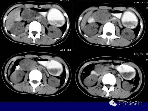 【病例】胰腺女儿瘤—实性假乳头状瘤1例CT影像表现