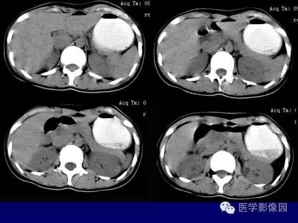 【病例】胰腺女儿瘤—实性假乳头状瘤1例CT影像表现