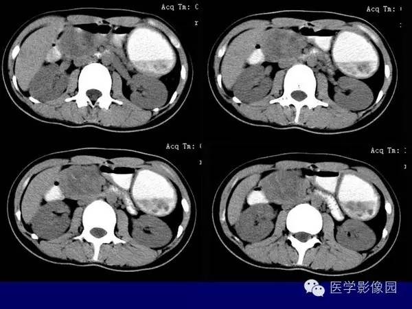 【病例】胰腺女儿瘤—实性假乳头状瘤1例CT影像表现