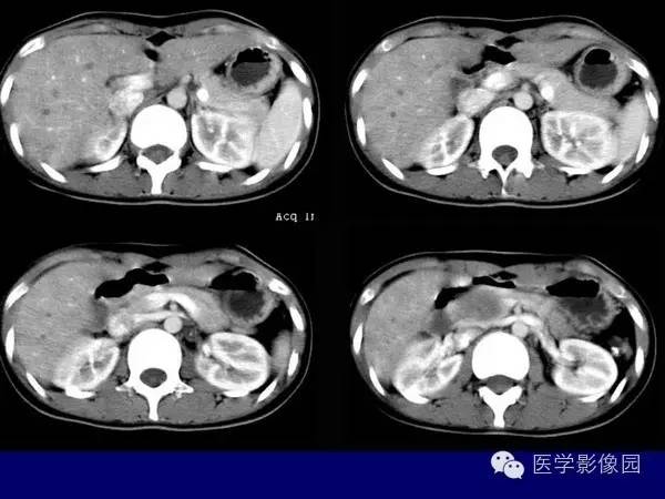 【病例】胰腺女儿瘤—实性假乳头状瘤1例CT影像表现