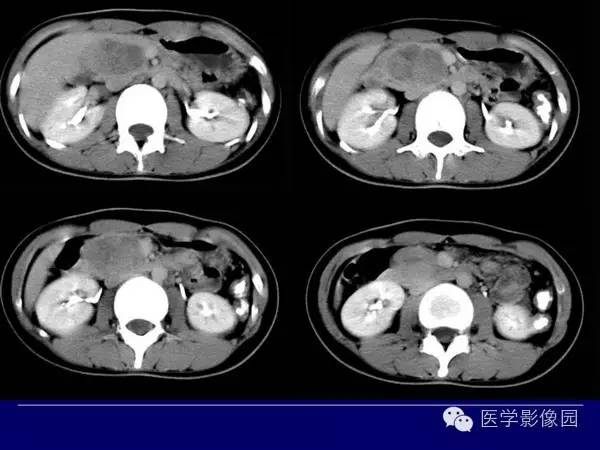 【病例】胰腺女儿瘤—实性假乳头状瘤1例CT影像表现