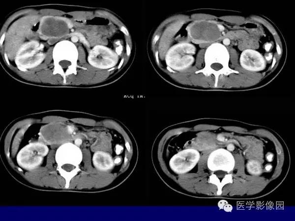 【病例】胰腺女儿瘤—实性假乳头状瘤1例CT影像表现