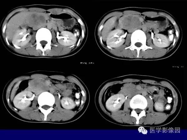 【病例】胰腺女儿瘤—实性假乳头状瘤1例CT影像表现