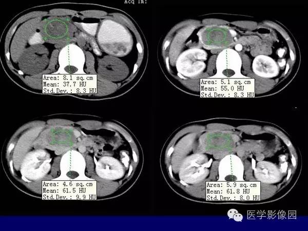【病例】胰腺女儿瘤—实性假乳头状瘤1例CT影像表现