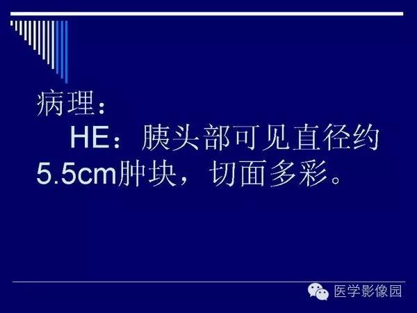 【病例】胰腺女儿瘤—实性假乳头状瘤1例CT影像表现