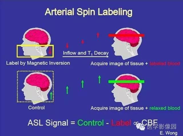 【PPT】磁共振ASL灌注成像在神经系统的应用