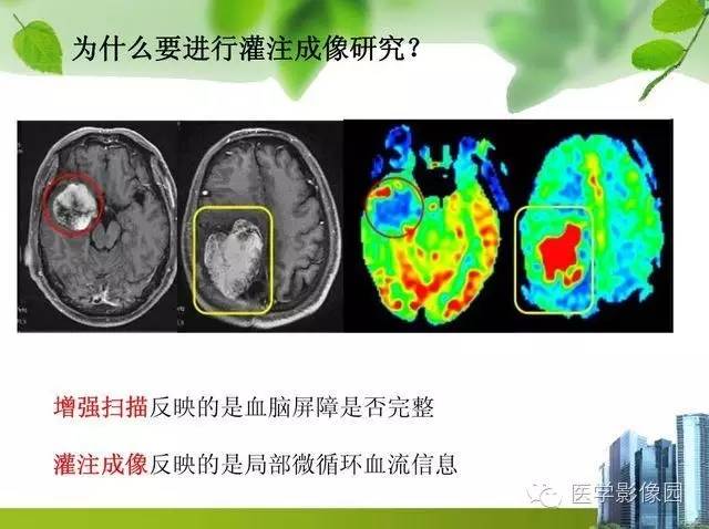 【PPT】磁共振ASL灌注成像在神经系统的应用