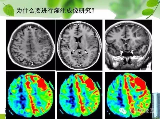 【PPT】磁共振ASL灌注成像在神经系统的应用