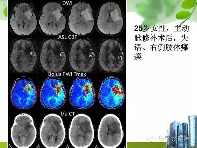 【PPT】磁共振ASL灌注成像在神经系统的应用