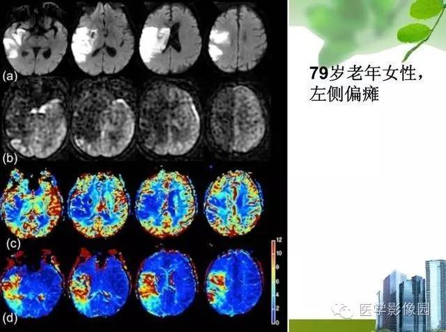 【PPT】磁共振ASL灌注成像在神经系统的应用