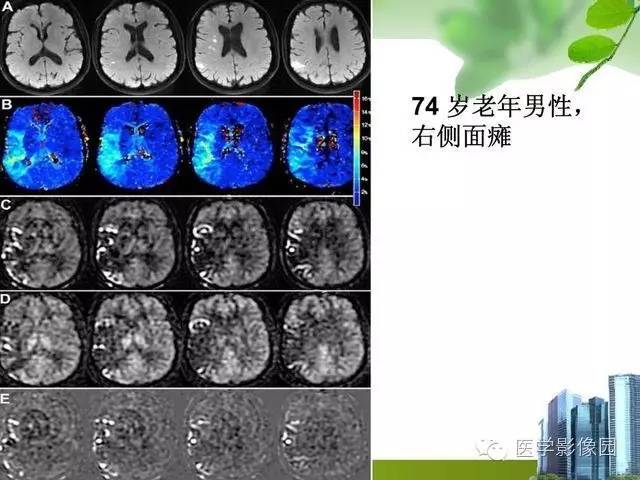 【PPT】磁共振ASL灌注成像在神经系统的应用