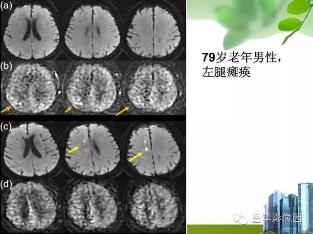 【PPT】磁共振ASL灌注成像在神经系统的应用