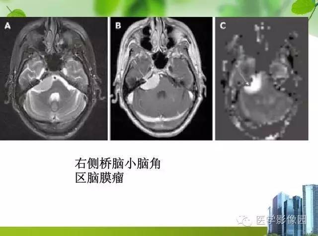 【PPT】磁共振ASL灌注成像在神经系统的应用