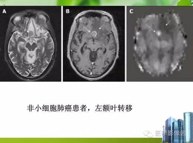 【PPT】磁共振ASL灌注成像在神经系统的应用