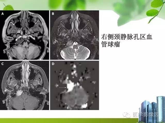 【PPT】磁共振ASL灌注成像在神经系统的应用